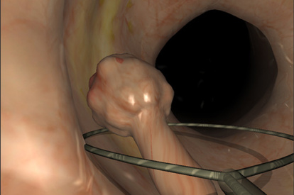 Módulo de Endoscopia do Trato Gastrointestinal Inferior