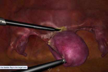 Modulo de Histerectomia