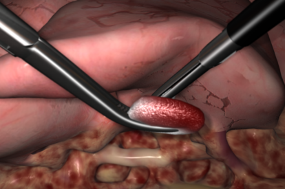 Modulo de Lobectomia por VATS