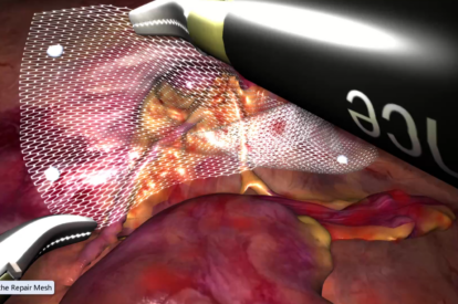 Modulo de Hernia Inguinal