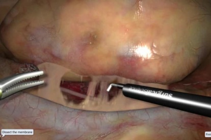 Modulo de Nefrectomia