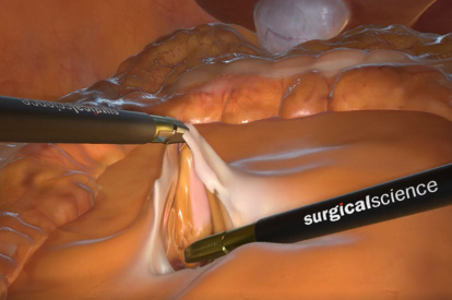 Modulo de Hemicolectomia
